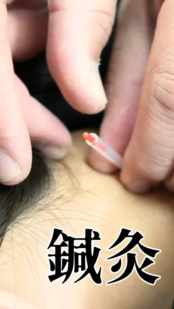 鍼灸